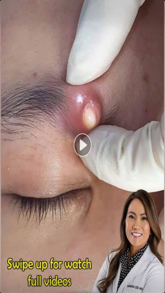 Why do pimples form